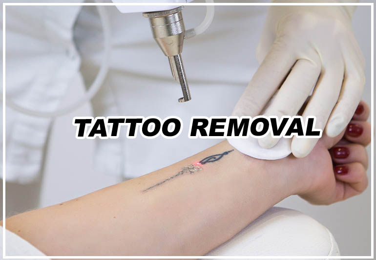 Tattoo Removal in Nagpur - Dr. Neha Rathi Cosmetologist